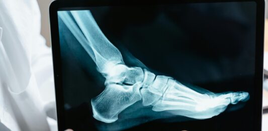 Běžecká zranění pohledem epigenetiky: Jak udržet klouby a šlachy zdravé?